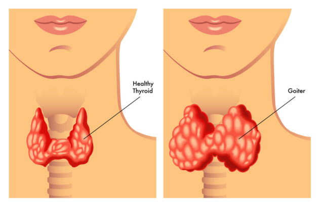 Powiększenie tarczycy może być spowodowane niedoborem jodu w diecie.
