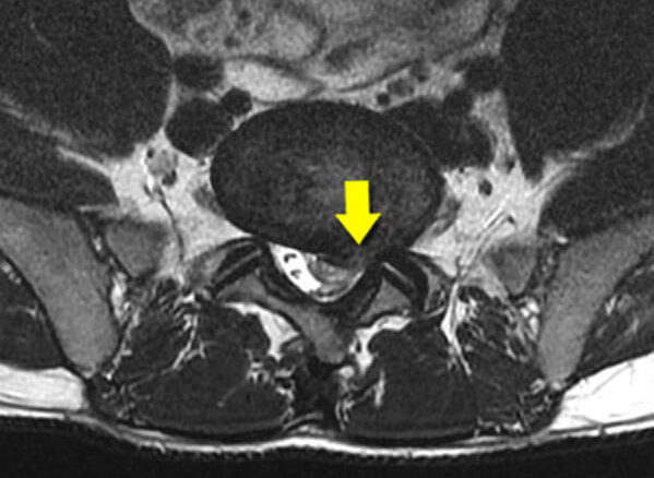 Dyskopatia cortaz częsciej występuje także u ludzi młodych przez siedzący tryb życia i niedostateczną ilość ruchu.